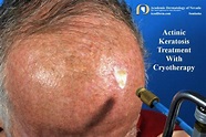 Actinic Keratosis: Treatment-Cryotherapy - Academic Dermatology of Nevada