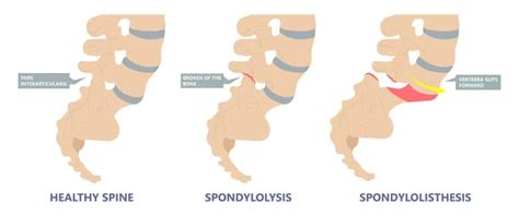 Spondylolisthesis Definition Causes Symptoms And Treatment Spine Info