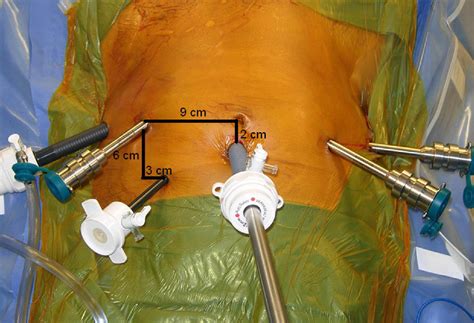 Extended Pelvic Lymph Node Dissection In Robotic Assisted Radical