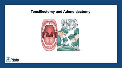 Tonsillectomy And Adenoidectomy Youtube