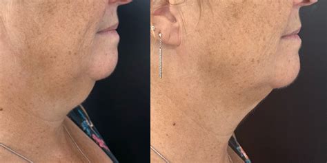 50 Off Double Chin Treatment With Fat Dissolving Injections