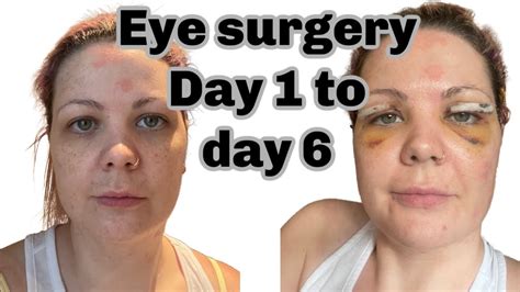 my blepharoplasty experience eyelid surgery and recovery day 1 to 6 youtube