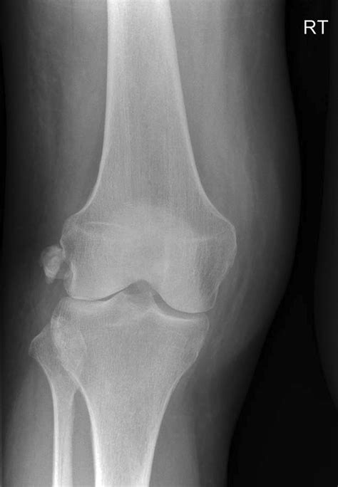 Acute Calcific Periarthiritis Of The Knee Presenting With Calcification