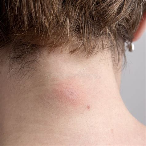 Insect Bite On Caucasian Skin Stock Photo Image Of Scab Neck 42299696
