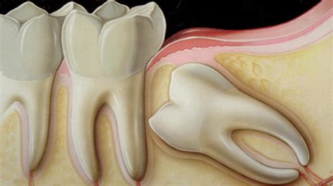 Hard Lump On Jaw After Wisdom Teeth Removal Teeth Poster