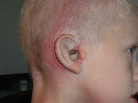 Did he stop playing cards when he was having his meal? Robbies Little Nubby: Hole in Ear Drum and Another ...
