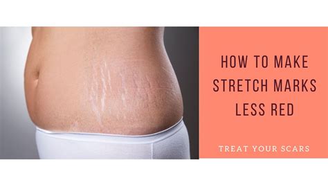 How To Make Stretch Marks Less Red Treat Your Scars