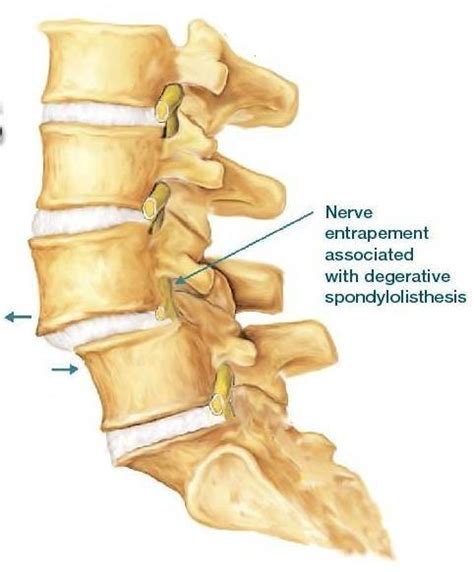 26 Best Ideas For Coloring Grade 1 Spondylolisthesis