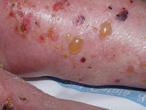 Autoimmune bullous dermatoses (aibds) are a group of rare chronic inflammatory skin diseases, which clinically manifest as blisters and erosions of the skin and/or mucosa. Bullous pemphigoid | Primary Care Dermatology Society | UK
