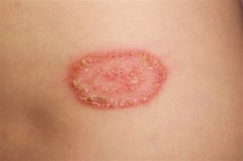 How To Get Rid Of Ringworm With Bleach ⋆ Beautynews Pumikai
