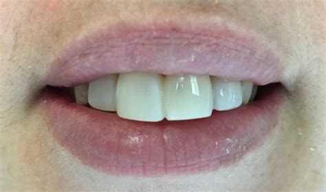 This particular solution is excellent for closing multiple gaps in a timely manner because they can be bonded directly to. Close Gap In Front Teeth In One Visit Without Braces ...