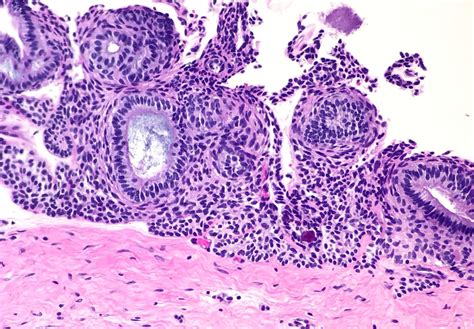 Pathology Outlines Adenomatoid Odontogenic Tumor