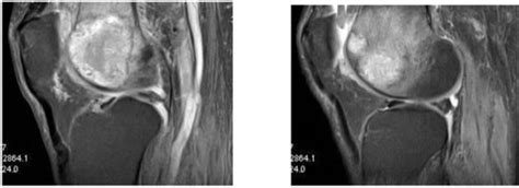 Magnetic Resonance Image Showing Knee Joint And Synovial Metastasis In