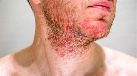 Dermatitis Seborreica Qué Es Síntomas Y Tratamientos Idp Dermocosmética