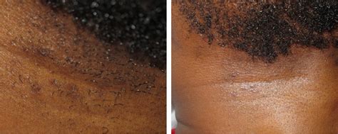 Laser Hair Removal For Dark Skin London Premier Laser Clinic