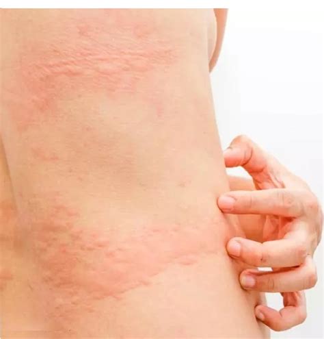 Hives Urticaria And Angioedema