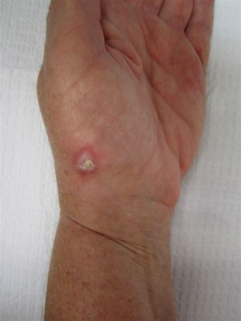 Lumps And Bumps And Cysts Of The Hand