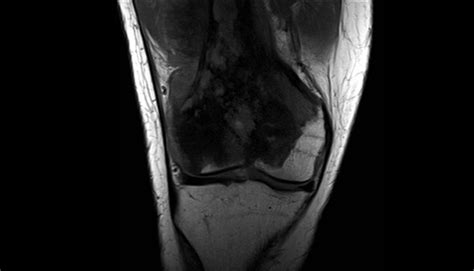Ortho Dx Pain And Swelling In The Right Knee Clinical Advisor