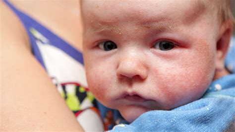 Download 44 Infantile Acne Eczema Rash On Baby Face
