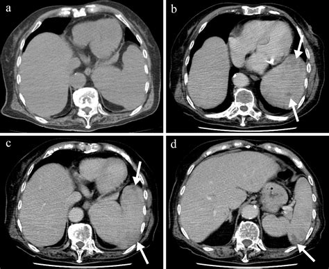 Primary Splenic Lymphoma An Uncommon Cause Of Persistent Fever