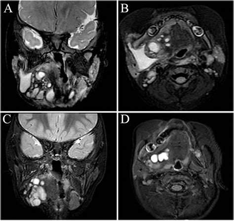 Classification Specific Lymphatic Malformations Management On Head And
