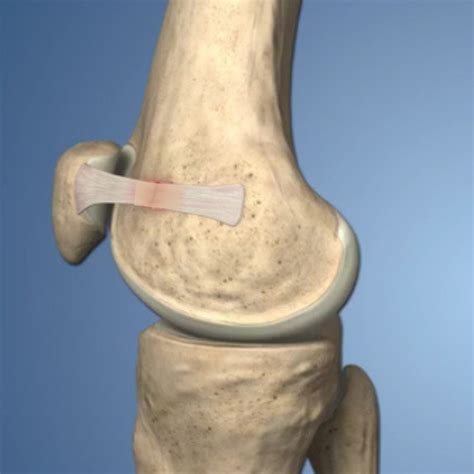 Kneecap Injuries Carolinas Pain Center Knee Pain Specialists