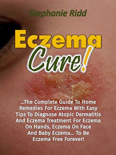 Eczema Cure The Complete Guide To Home Remedies For Eczema With Easy