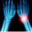 Wrist Pain & Arthritis  Chatham Orthopaedics