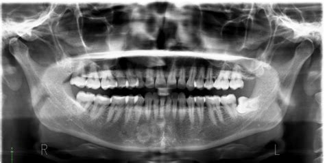 Dental X Ray Radiographs Test In Delhi Full Mouth Rvg And Opg X Ray