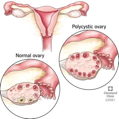 Pcos Polycystic Ovary Syndrome Symptoms Treatment