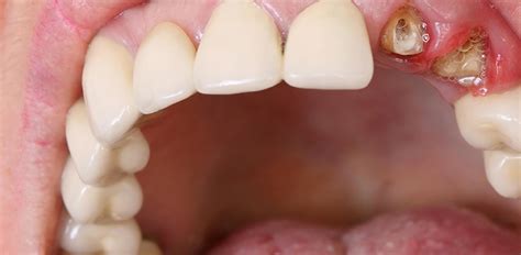 Decayed Teeth Emergency Dentist Berkshire Slough 24 Hour