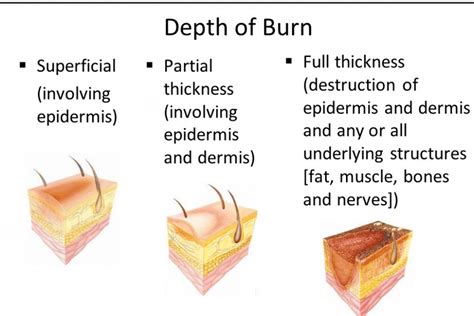 Assessment And Referral Of Burn Patients Department Of Surgery