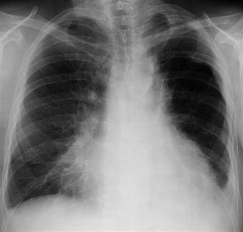 Learn about causes, risk factors, prevention, signs and symptoms. Aspiration Pneumonia