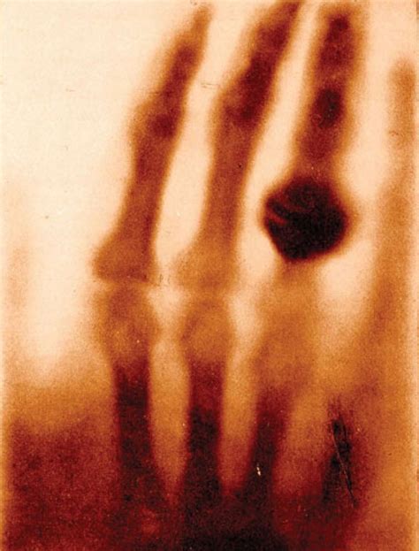 Worlds First Human X Ray 1895 Röntgens Wife Hand