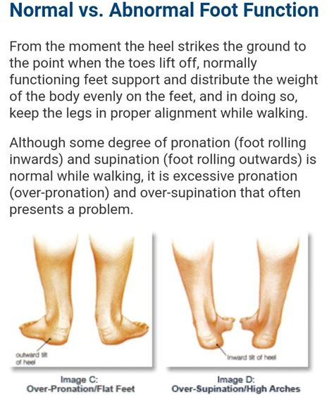 Pin On Pronation Foot Disorder