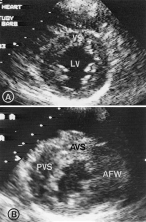 Development Of Left Ventricular Hypertrophy In Adults With Hypertrophic