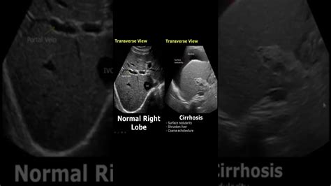 Liver Cirrhosis On Ultrasound Ascites Chronic Liver Disease Usg Normal Vs Abnormal Shorts