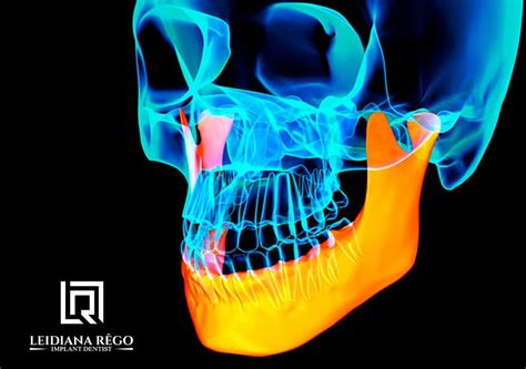 Enxerto Ósseo Para Implantes Dentários Dentista Especialista Em Manaus