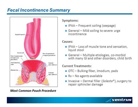 Ven 308 Topical Phenylephrine Novel Treatment For Fecal Incontinence