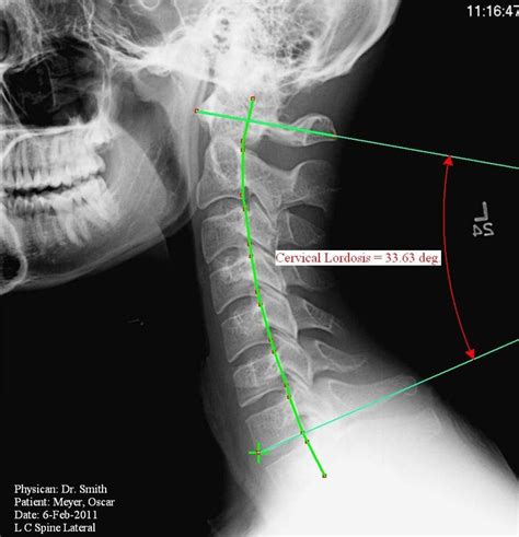 Guided Mark Up Cervical Spine Measurements Metron Imaging