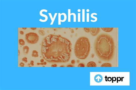 Syphilis Symptoms Treatment Diagnosis Prevention