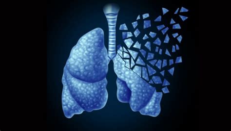 Radiation And Pulmonary Fibrosis Vanderbilt News Vanderbilt University