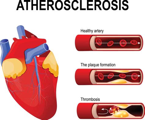 Atherosclerosis Anatomy