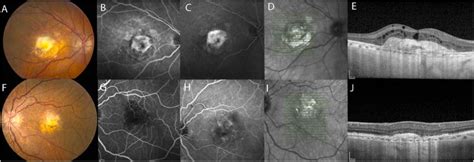 Fibrosis In Neovascular Age Related Macular Degeneration A Review Of