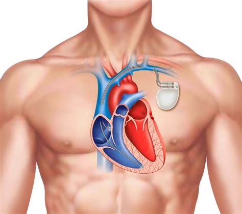 Pacemakers Oscestop Osce Learning