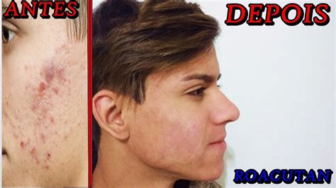 Antes E Depois Do Roacutan Youtube