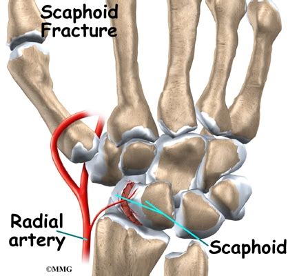 Scaphoid Fracture Of The Wrist Orthogate