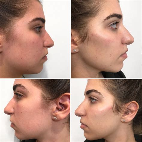 Cheek Fillers Sydney To Offer A Fresh And Rested Look
