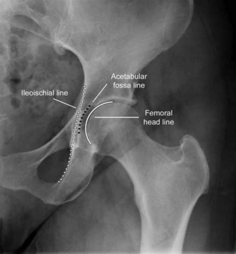 Normal Hip Anteroposterior Radiograph Of The Left Hip Demonstrates The