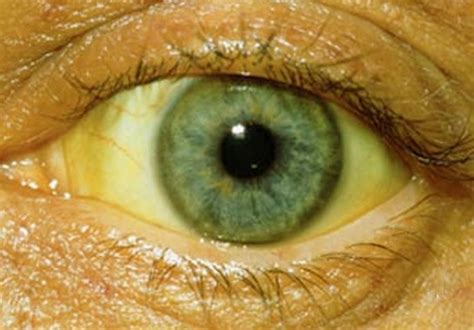 Yellowing Of The Eyes Causes Treatment Pictures 2018 Updated